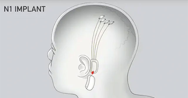 Cuộc Cách Mạng Công Nghệ Nhờ Thử Nghiệm Cấy Chip Não Từ Neuralink