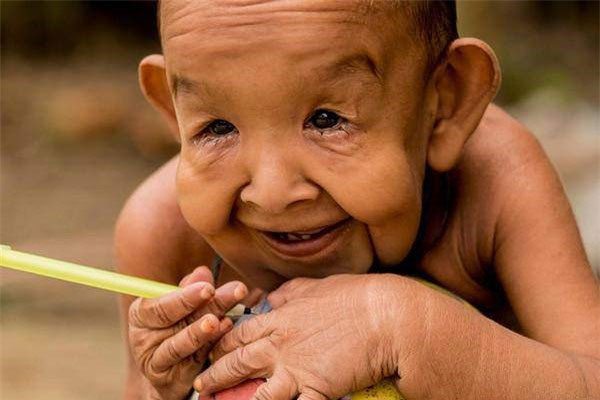 Hội chứng lão hóa sớm Hội chứng lão hóa sớm