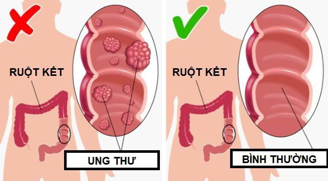 loi-ich-khi-an-dua-chuot-moi-ngay-2 Giảm thiểu nguy cơ ung thư
