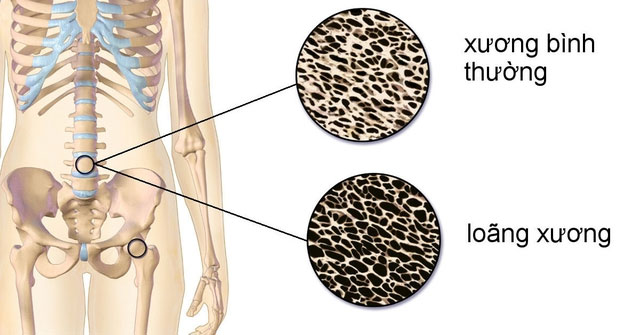 4 Loại Thực Phẩm Cần Tránh Để Giữ Cho Xương Khỏe Mạnh