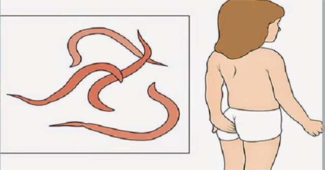 Bắt giun kim cho trẻ: phương pháp dân gian, hiệu quả và những điều cần biết